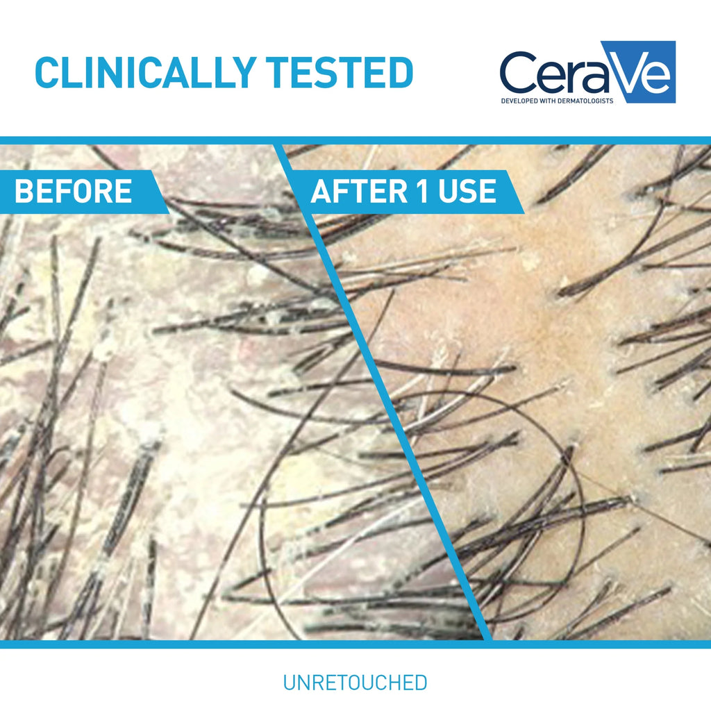 Hydrating anti Dandruff Shampoo Sulfate Free & Color Safe Itchy Scalp Treatment