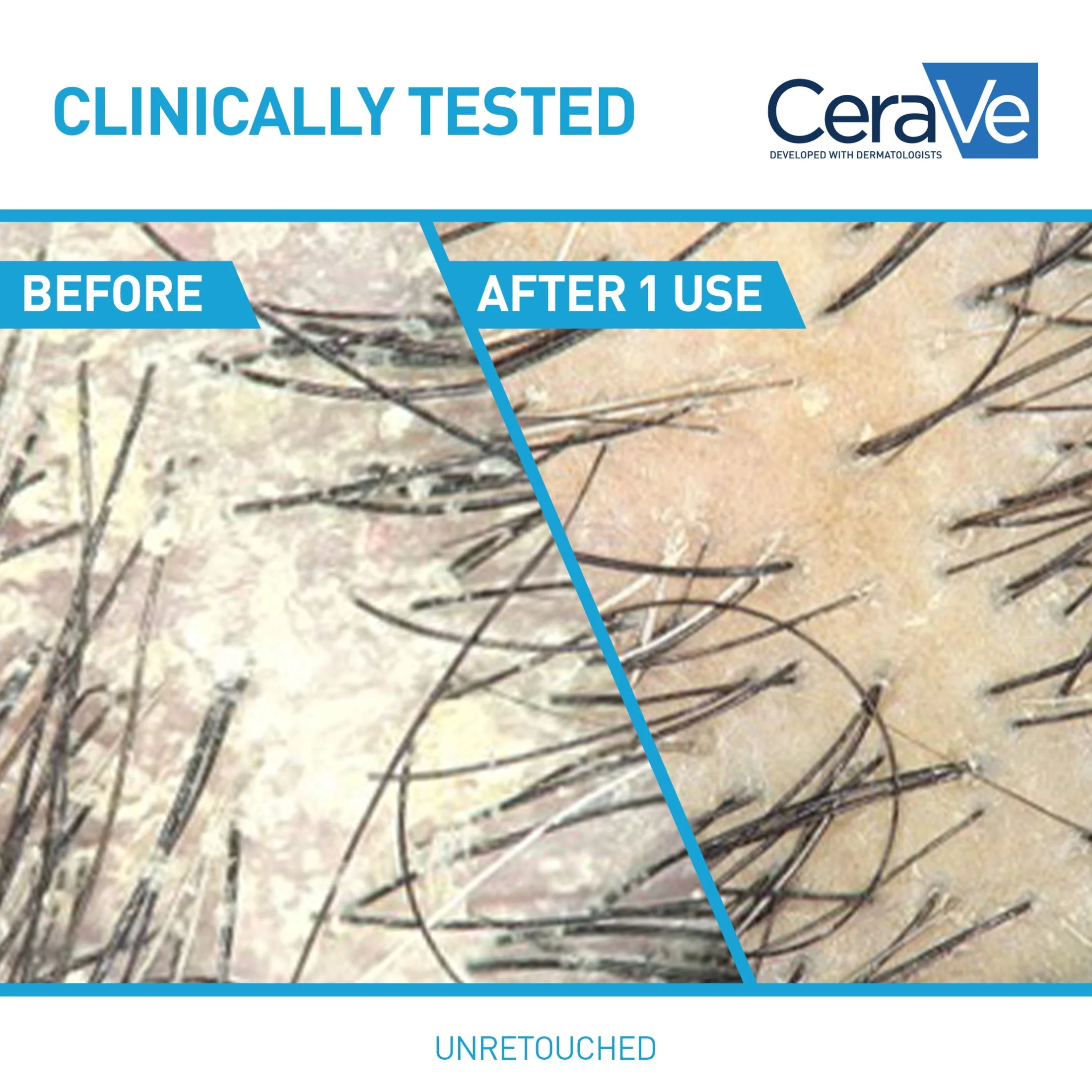 Hydrating anti Dandruff Shampoo Sulfate Free & Color Safe Itchy Scalp Treatment